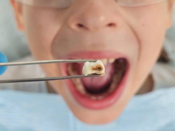 Best Emergency Tooth Extraction in West Columbia, SC